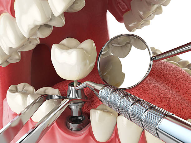 Best Urgent Care for Lost Fillings or Crowns in Geneseo, IL